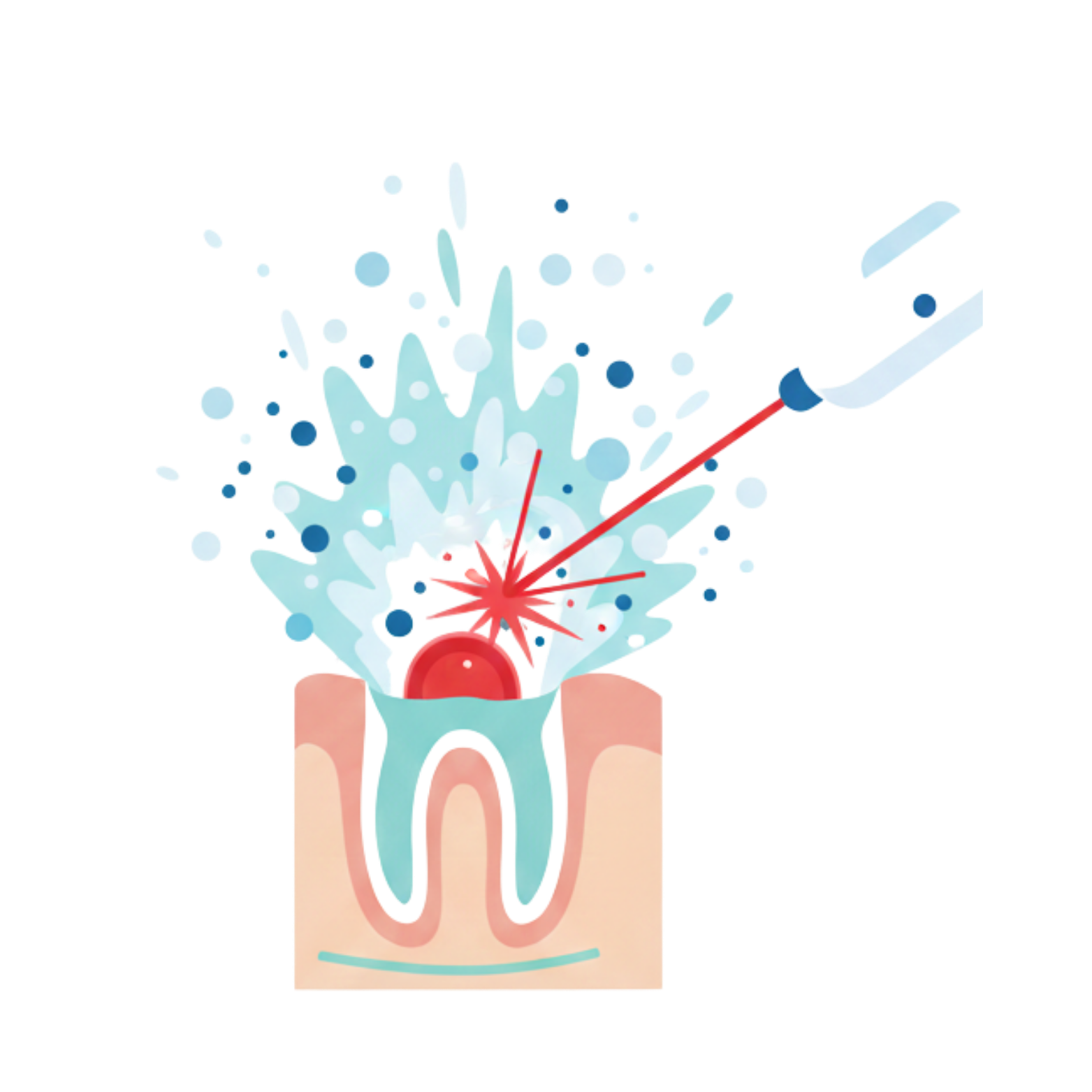 Dental Laser Prosedure