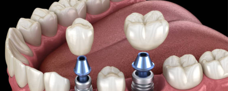 Dental Implants