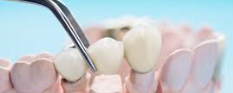 Replacement of Missing Teeth