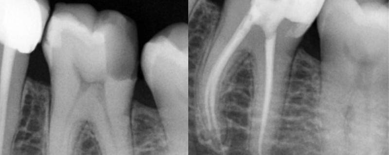 Root Canal Treatment