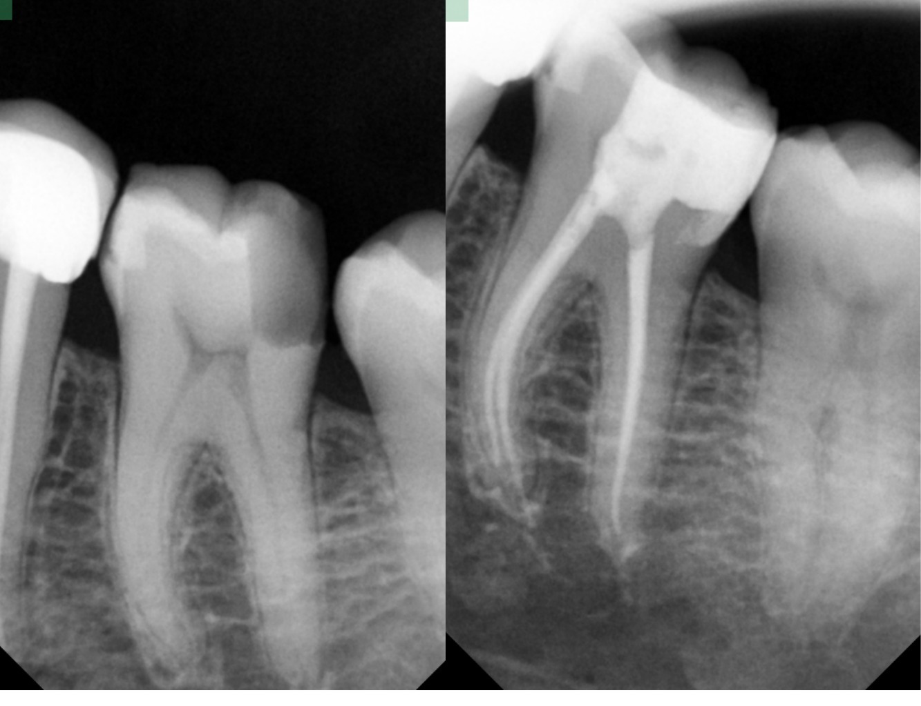 Root canal treatment