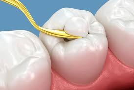 Tooth Coloured Filling